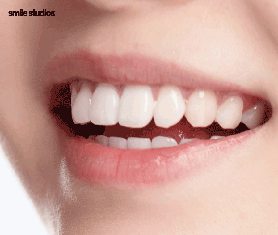 치아사이 벌어짐 가지런한 앞니 만드는 Tip 관련 이미지 5