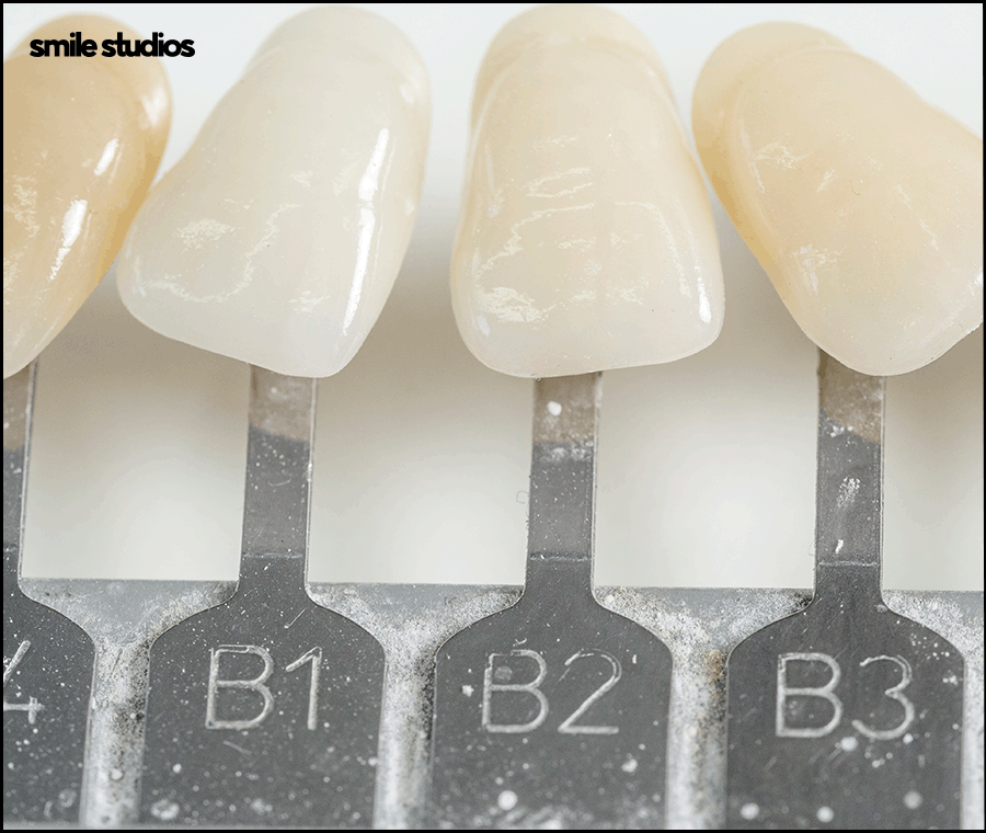 라미네이트 교정 효과를 기대할 수 있는 케이스는? 관련 이미지 2