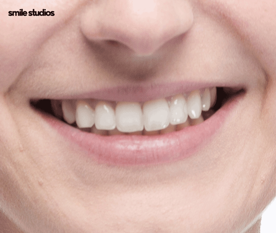 앞니 살짝 깨짐 라미네이트로 대처 가능한 수준은? 관련 이미지 9