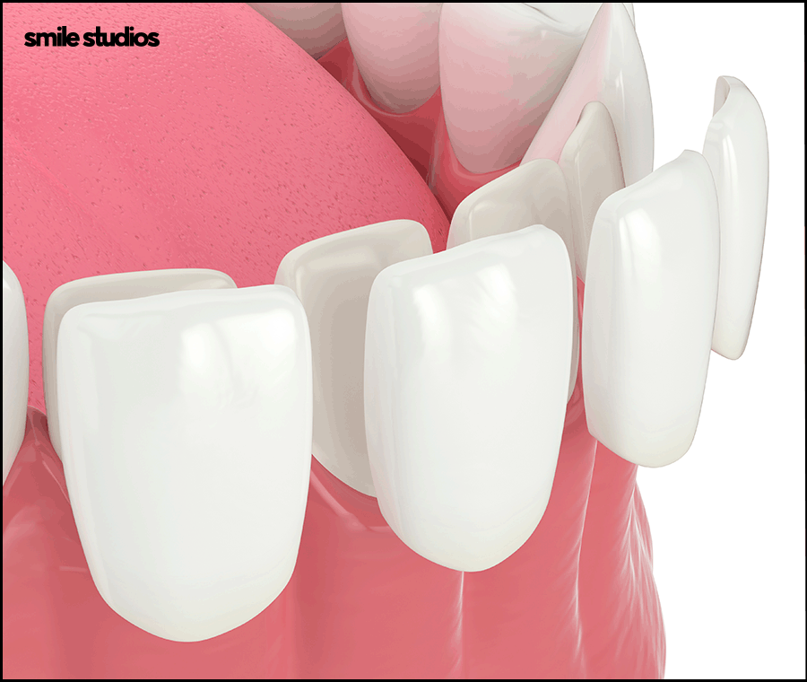 라미네이트 교정 효과를 기대할 수 있는 케이스는? 관련 이미지 3