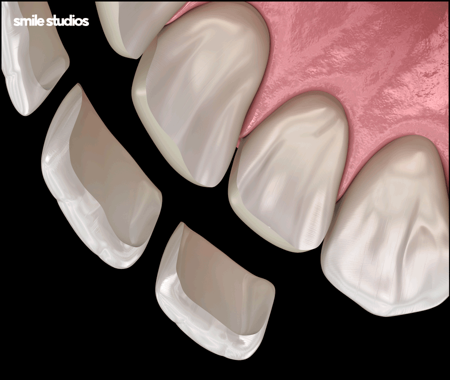 라미네이트 깨짐 대처, 어떻게 해야할까요? 방법 정리 관련 이미지 5
