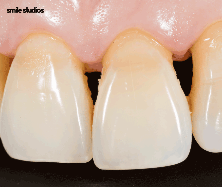 치아 사이 검은색 나타나는 이유, 회복 방법은? 관련 이미지 2