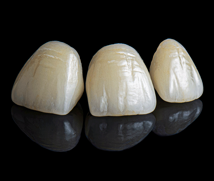 Why Are Veneers Preferred for Gaps Between the Front Teeth? image 5