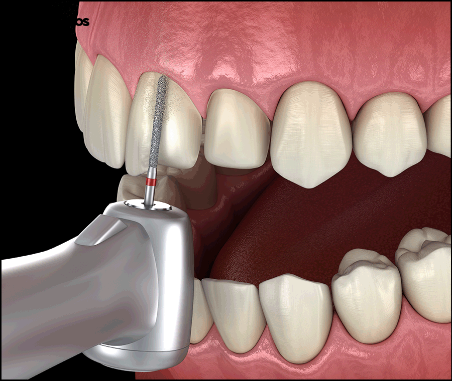 강남역 치과 라미네이트 섬세한 접근의 중요성 관련 이미지 3