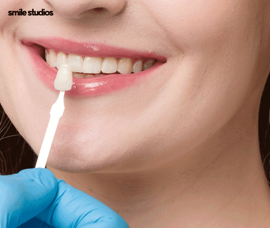 압구정로데오치과 라미네이트 하기 전 체크할 사항 관련 이미지 8