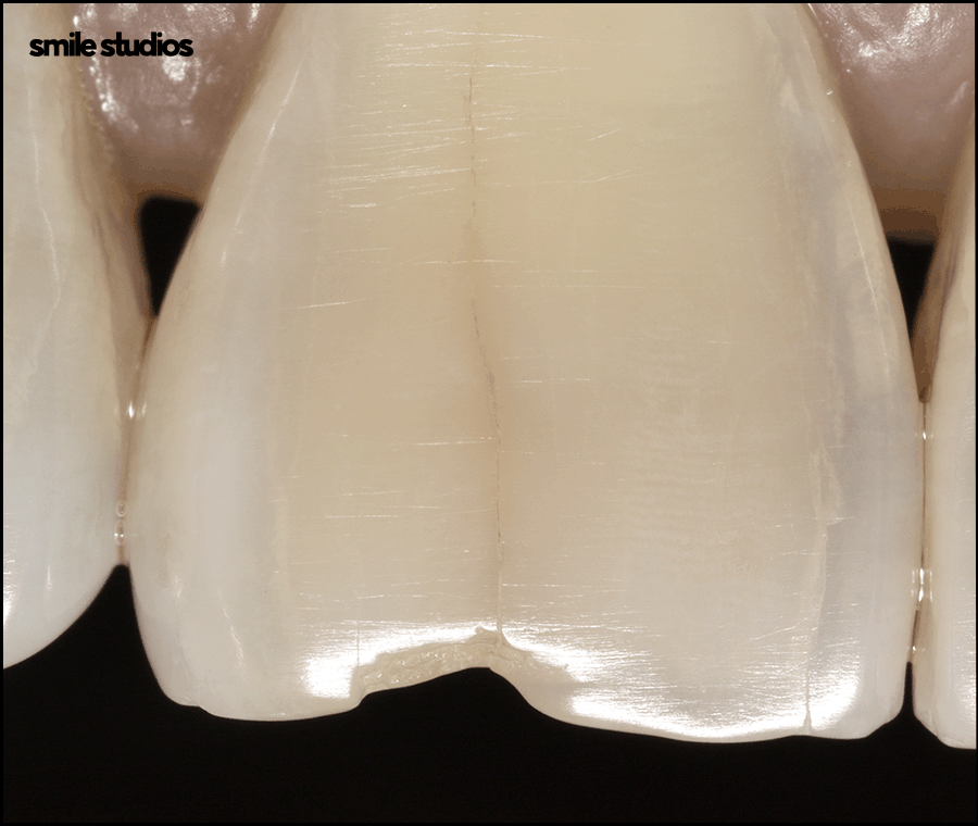 심미보철 가격, 기준, 시술 전 확인사항 총 정리 관련 이미지 2
