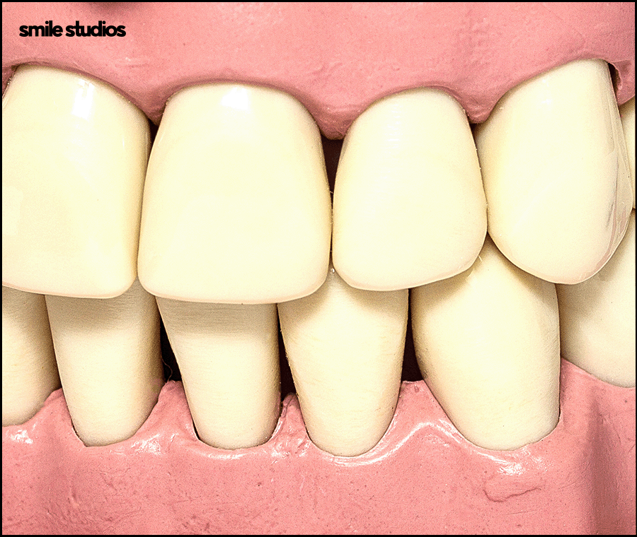 압구정로데오치과 라미네이트 하기 전 체크할 사항 관련 이미지 4