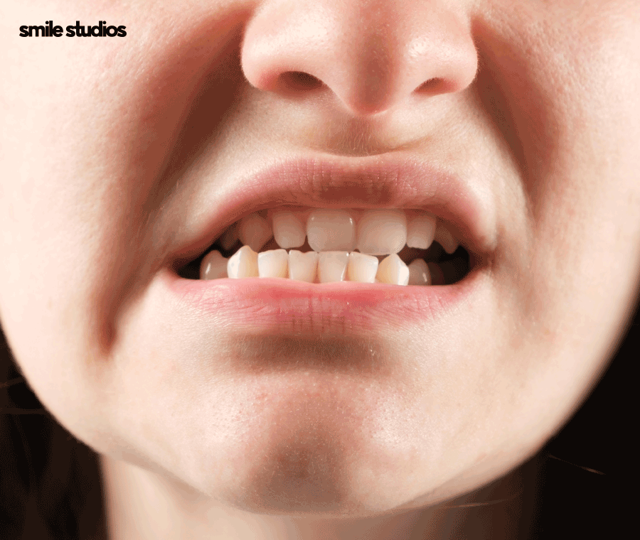 50대 치아교정 늦지 않은 이유, 방법, 효과 정리 관련 이미지 8