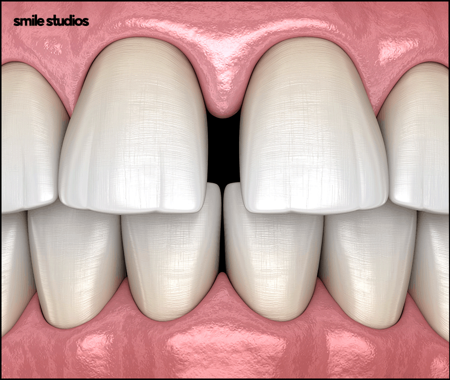 앞니 라미네이트가격 확인 시 같이 체크할 OO은? 관련 이미지 4