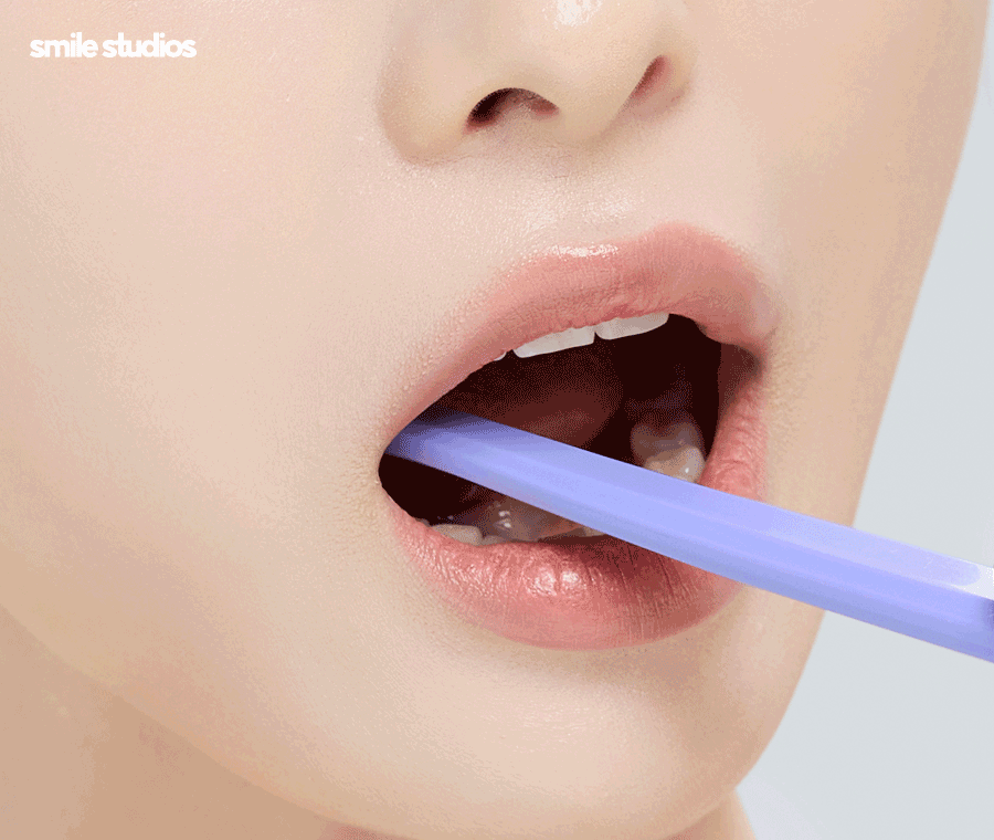 라미네이트제거 시기 및 유지력, 알아둘 사항 관련 이미지 7