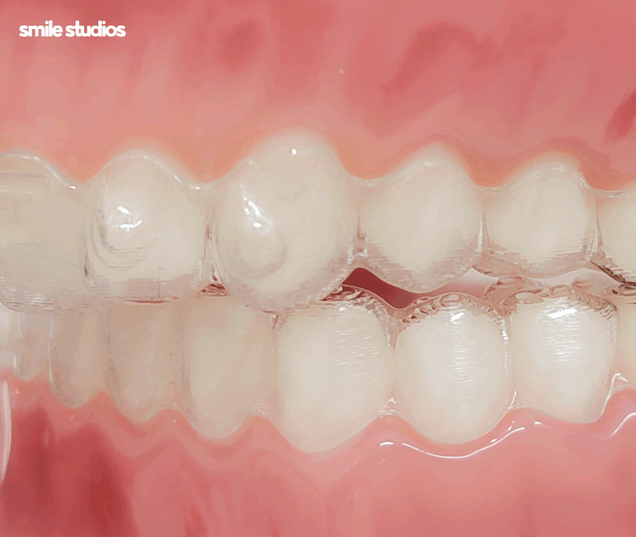 강남 논현 치과 투명 치아교정 시작 전 확인사항 관련 이미지 7