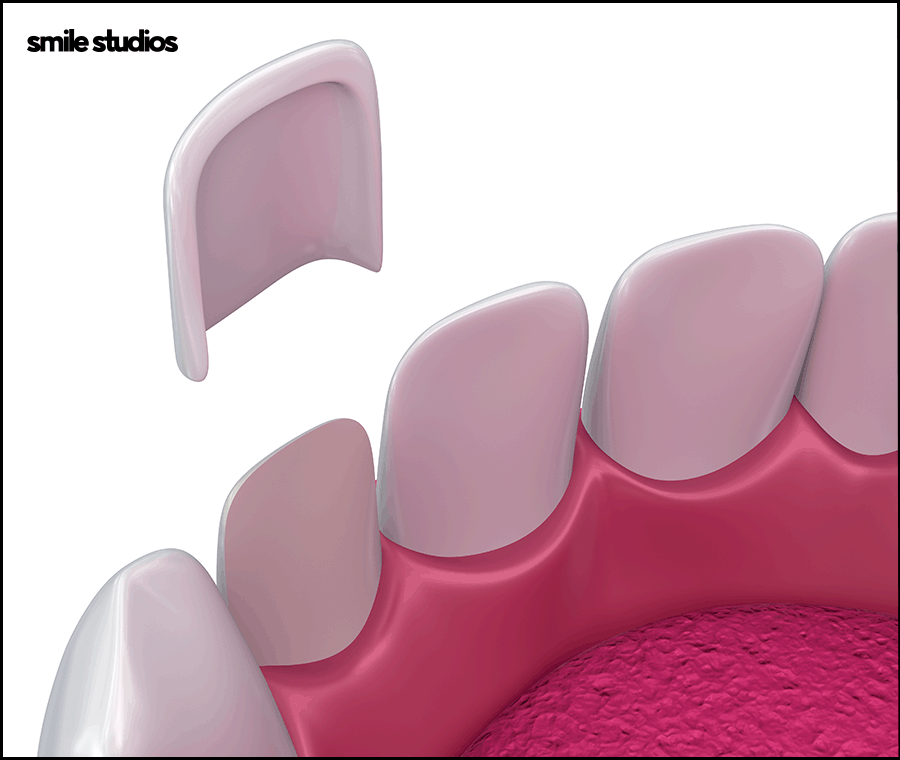 치과라미네이트 고른 치아 만들 때 핵심은? 관련 이미지 8