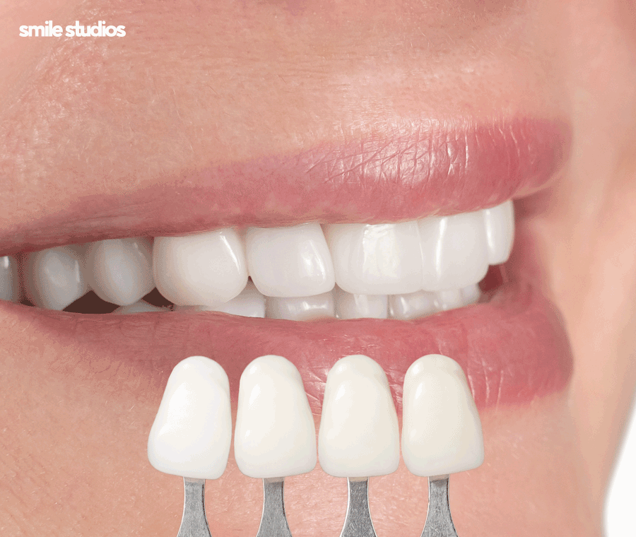 라미네이트 깨짐 대처, 어떻게 해야할까요? 방법 정리 관련 이미지 8