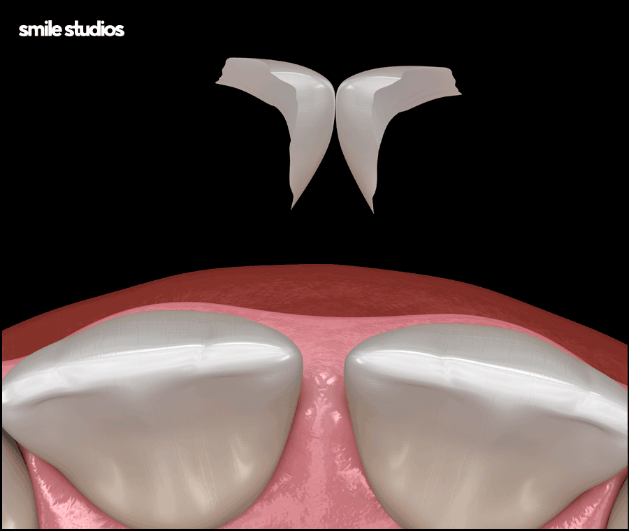 라미네이트 교정 효과를 기대할 수 있는 케이스는? 관련 이미지 9