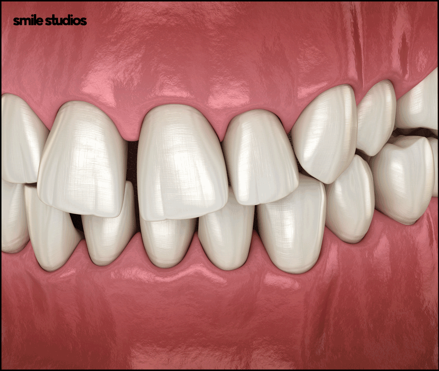 강남치과의원, 나노라이너 특징 및 효과 알아보기 관련 이미지 6