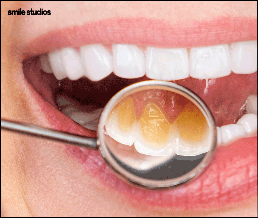 압구정로데오치과 라미네이트 하기 전 체크할 사항 관련 이미지 3