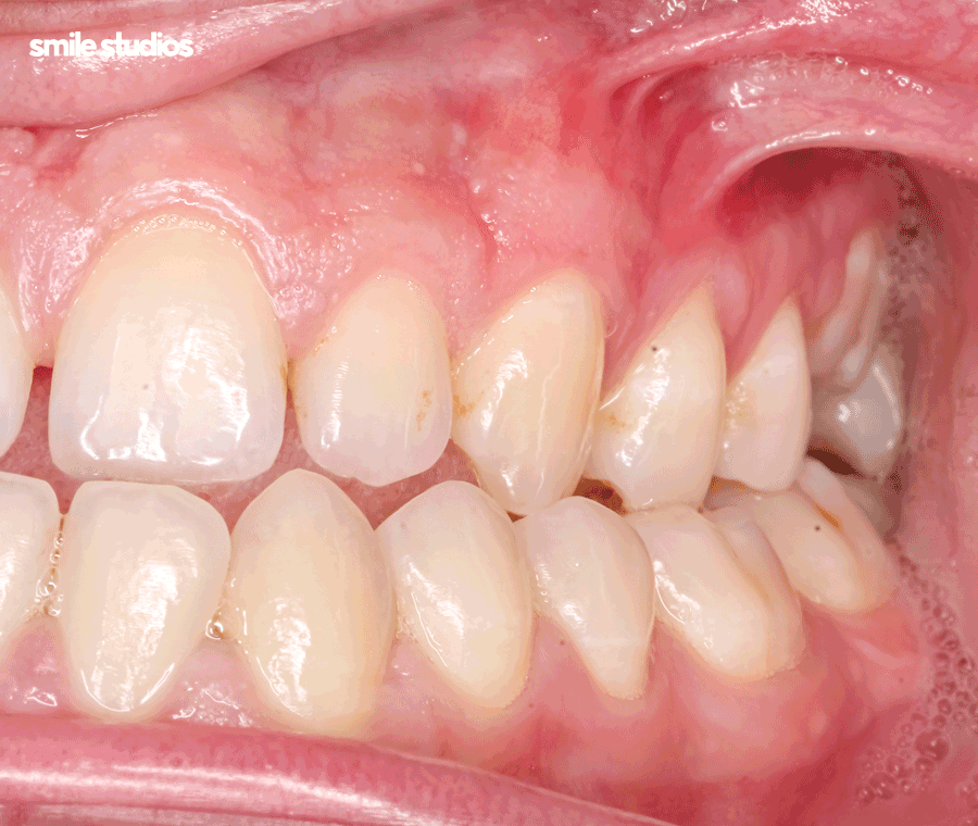 압구정 교정치과 인비절라인, 나노라이너 선택 기준 관련 이미지 6