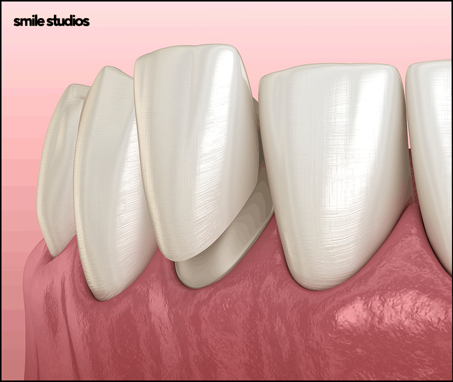 라미네이트 빠짐, 재부착 가능할까요? +대처방법 관련 이미지 2