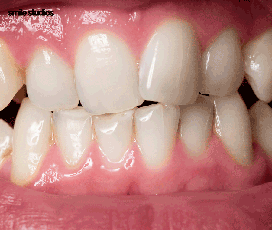 인비절라인 부작용, 장단점 총 정리해 드립니다 관련 이미지 2