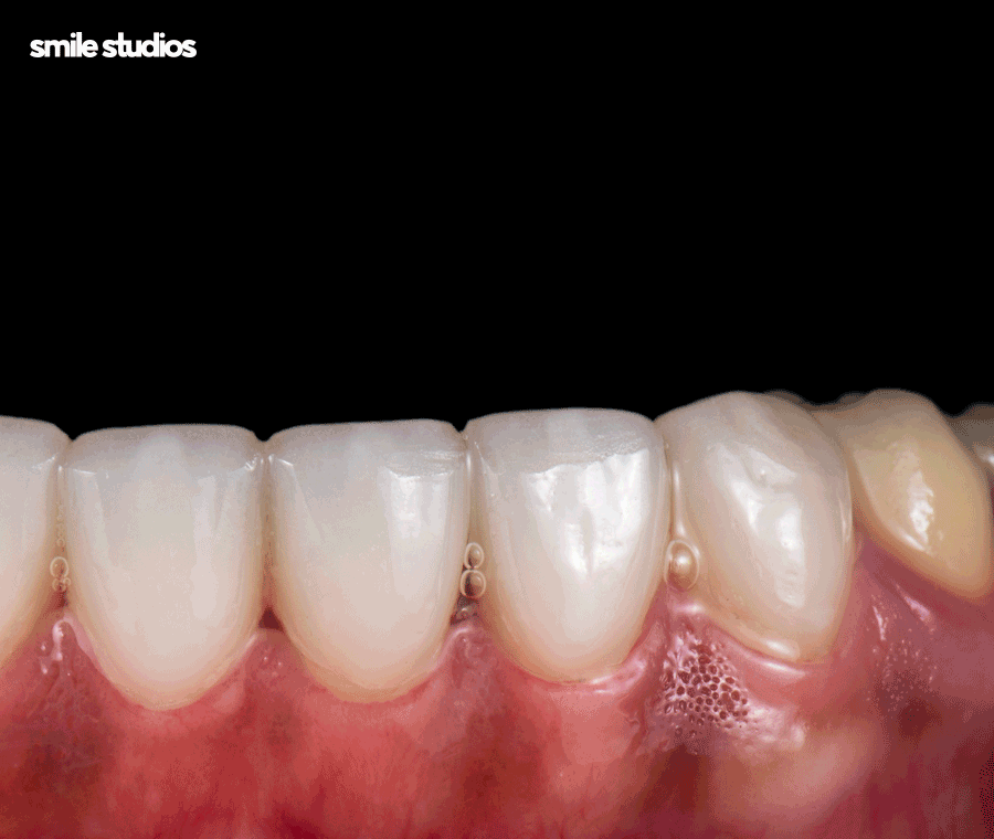 라미네이트제거 시기 및 유지력, 알아둘 사항 관련 이미지 2