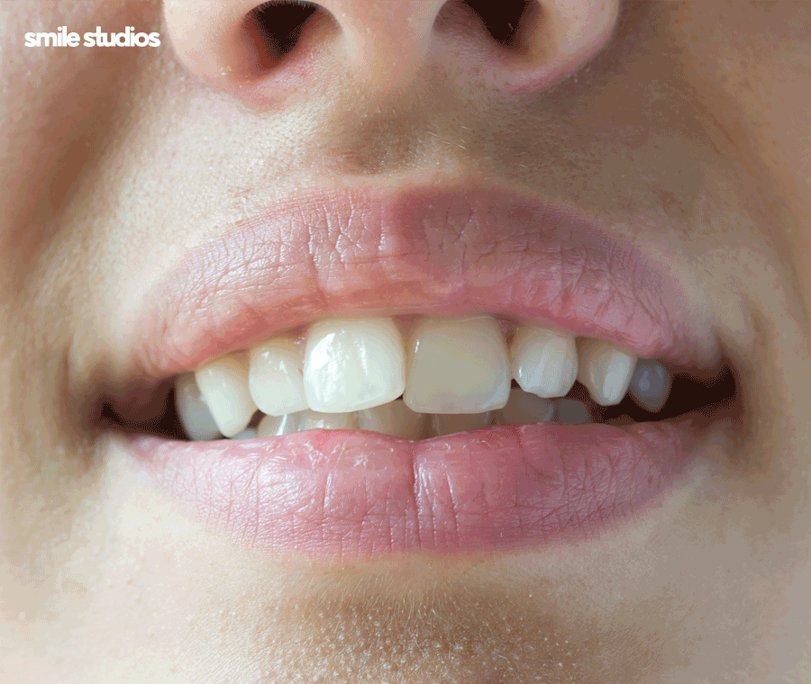 압구정 교정치과 인비절라인, 나노라이너 선택 기준 관련 이미지 2