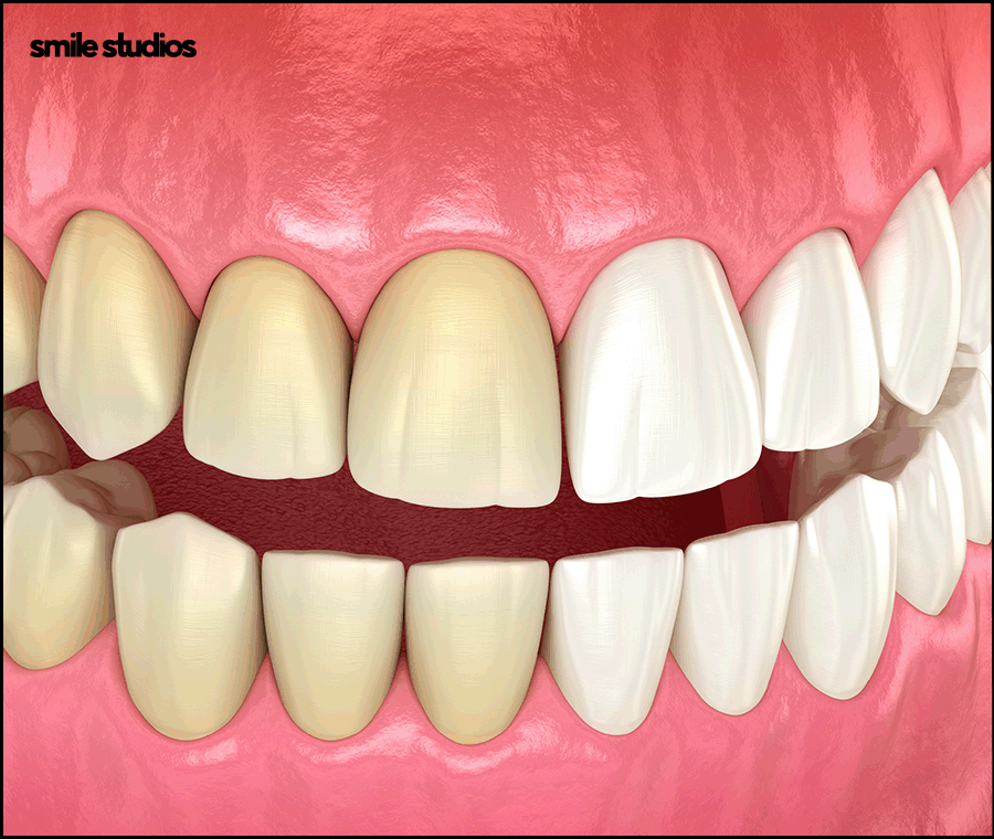 치아무삭제라미네이트 사실과 오해 알아보기 관련 이미지 5