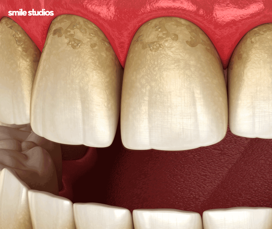 치아 사이 검은색 나타나는 이유, 회복 방법은? 관련 이미지 8