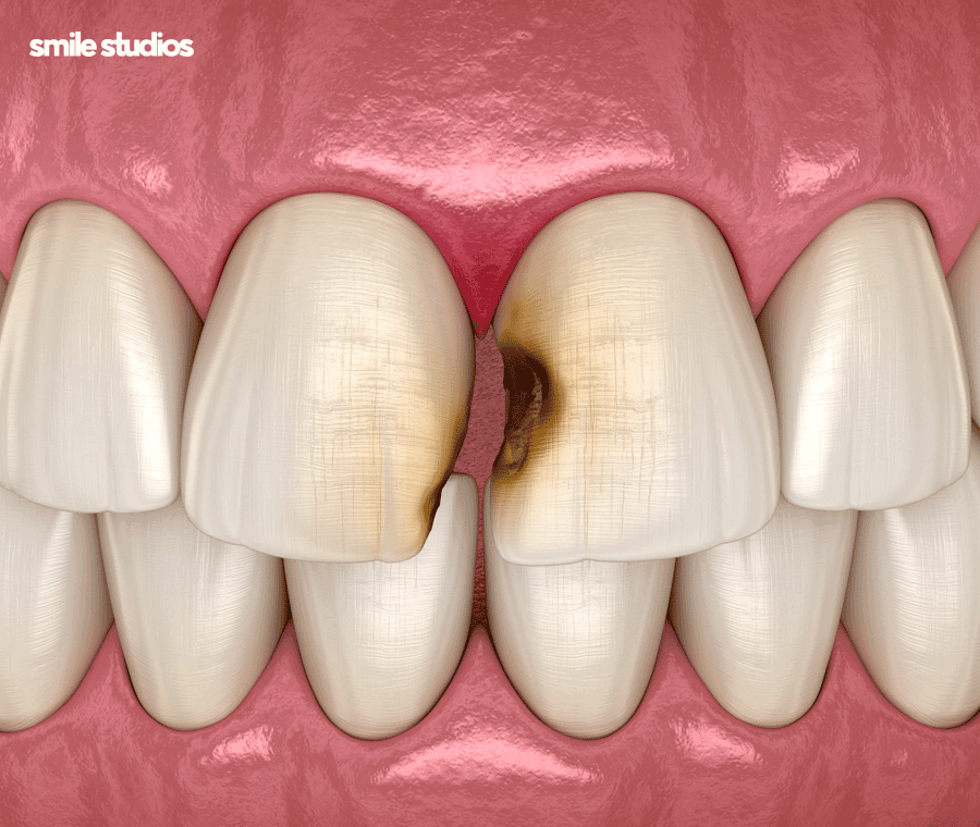 이빨깨짐 치료 치기를 놓치면 위험한 이유는? 관련 이미지 4