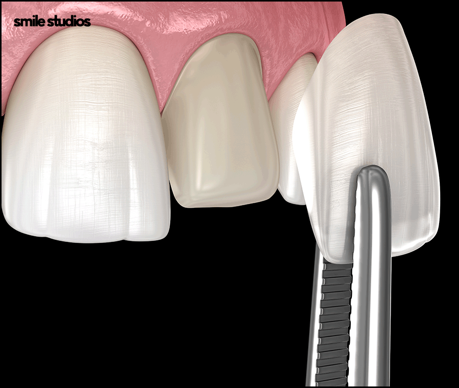 Why Are Veneers Preferred for Gaps Between the Front Teeth? image 8