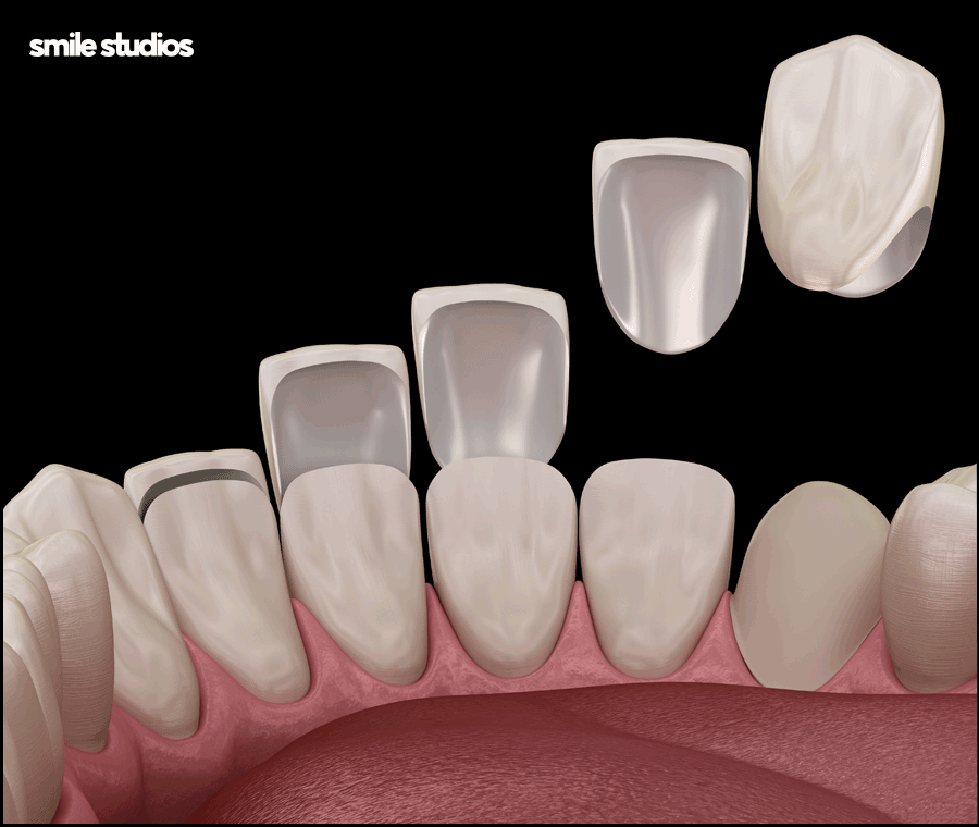 라미네이트 교정 효과를 기대할 수 있는 케이스는? 관련 이미지 6