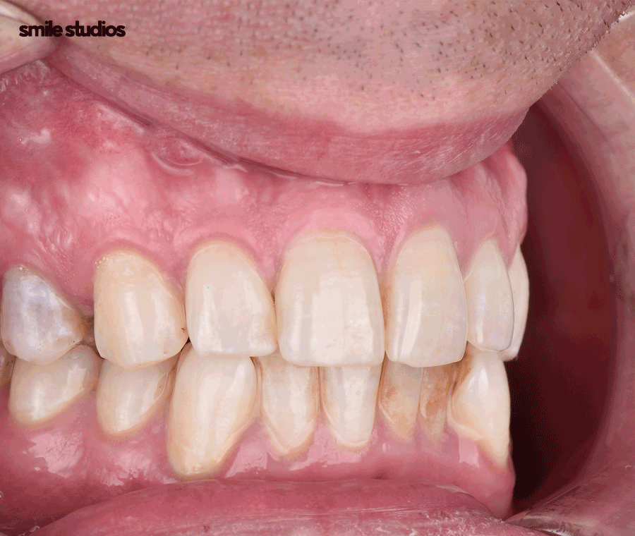 부정교합 치아교정 비용 다른 이유, 함께 체크할 사항 관련 이미지 9