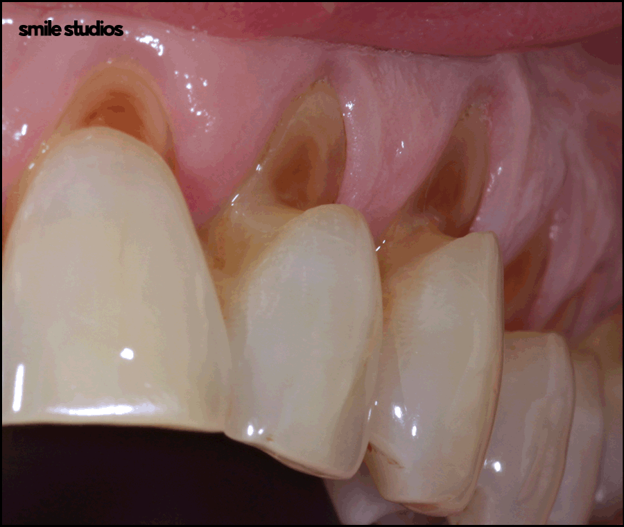 치경부마모증, 주저앉은 잇몸? 원인과 해결 방법 관련 이미지 5