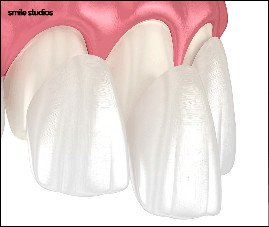 앞니무삭제라미네이트 핵심이 되는 사항은? 관련 이미지 6