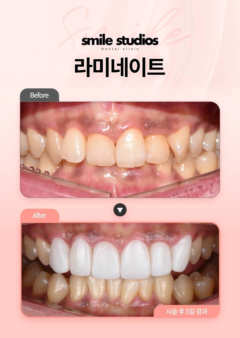치과라미네이트, 앞니 크기 불균형? 이젠 섬세한 차이로 완성하세요 관련 이미지 8