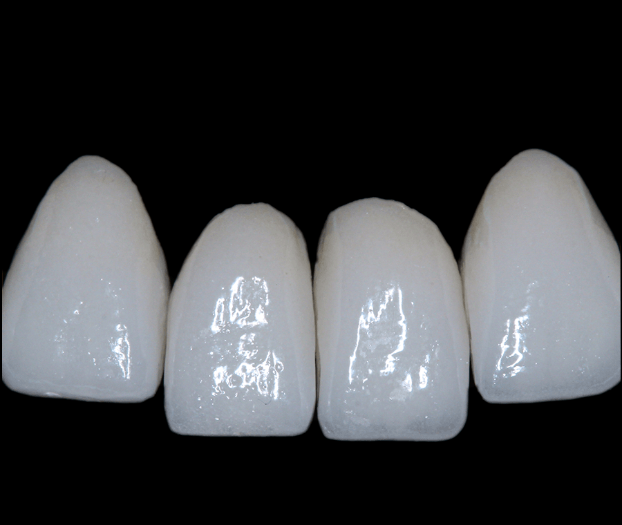 신논현역치과, 라미네이트 시술 전 꼭 확인할 핵심 2가지 관련 이미지 6