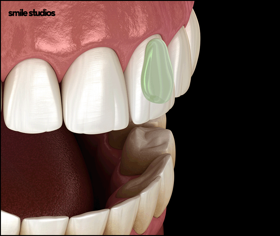 A Complete Guide to Laminate Replacement Timing, Lifespan, and Precautions image 5