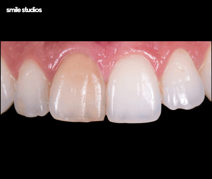 연예인라미네이트 선호도가 높은 이유, 효과 관련 이미지 9