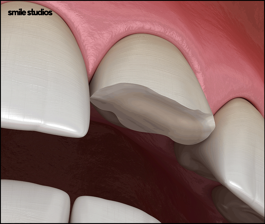 앞니부러짐 치아파절 대처 방법은? ft. 라미네이트 관련 이미지 4