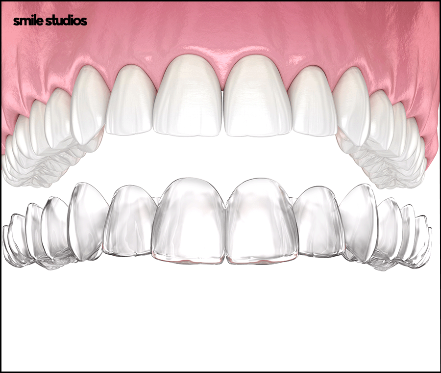 인비절라인 통증이 적은 결정적인 이유 알아보기 관련 이미지 4