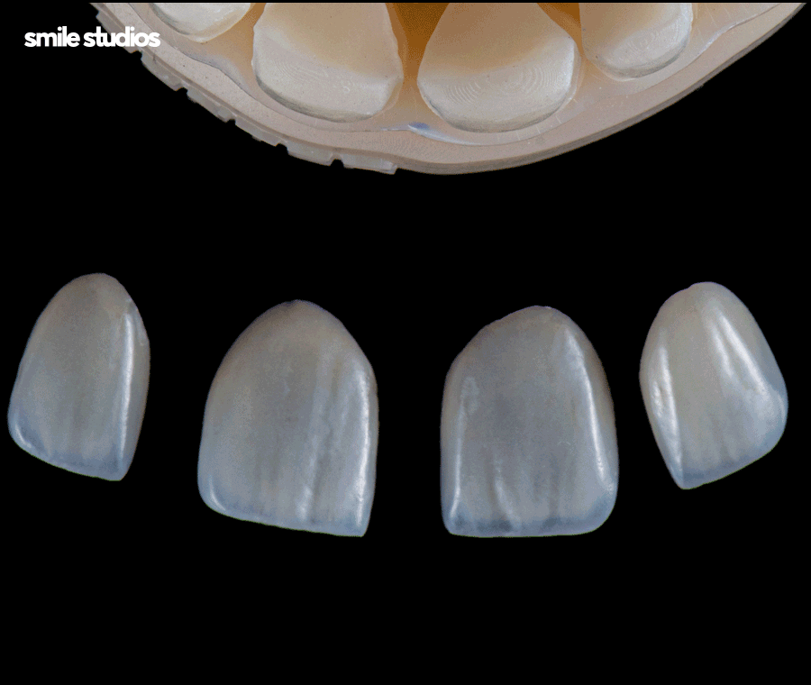 심미보철 가격, 기준, 시술 전 확인사항 총 정리 관련 이미지 6