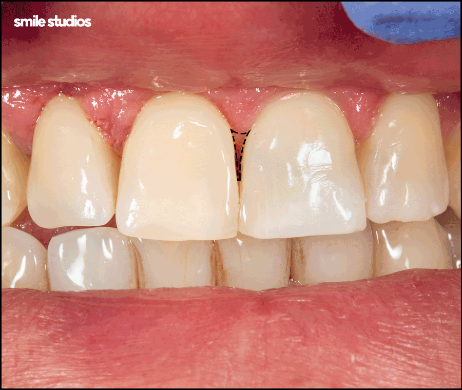 앞니 블랙트라이앵글 보완을 위한 라미네이트 효과 관련 이미지 8