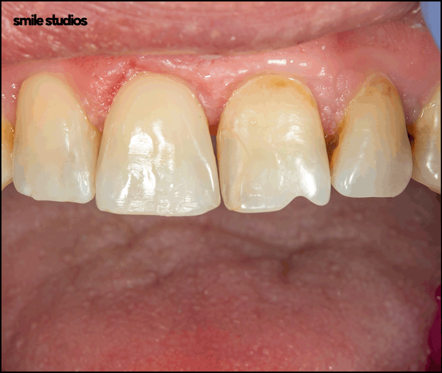 블랙트라이앵글 치료 적합한 방법 알아보기 관련 이미지 6