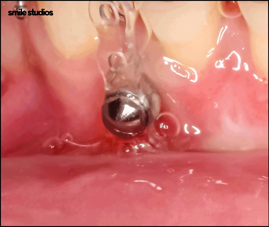 인비절라인 고무줄 착용해야 할까요? 기능 확인 관련 이미지 7