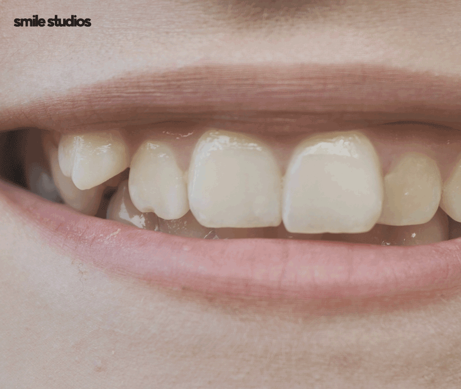 앞니 살짝 깨짐 라미네이트로 대처 가능한 수준은? 관련 이미지 2