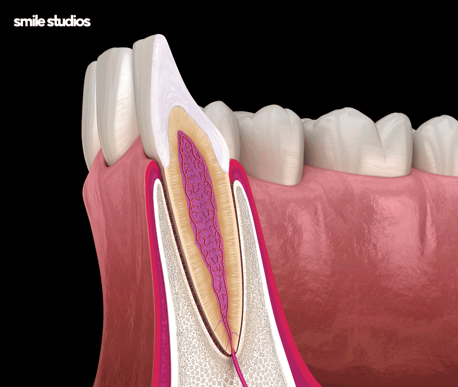 서초 신논현 치과 무삭제 라미네이트 특징, 장단점 관련 이미지 3