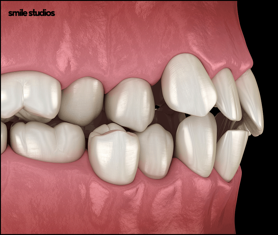 잠원동치과 투명교정 나노라이너, 인비절라인 비교 관련 이미지 2