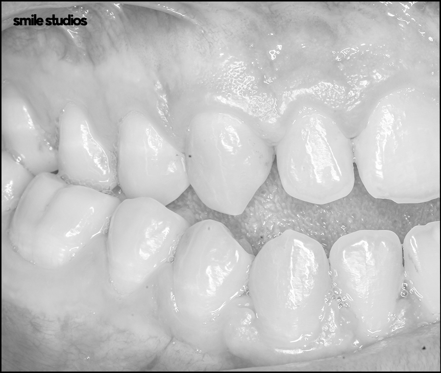 잠원동치과 치아교정 관련 이미지 8