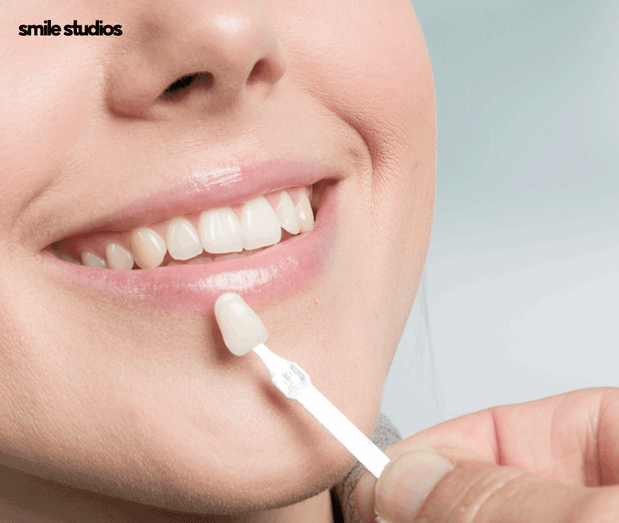 라미네이트 변색, 발생하는 이유, 시점, 대처 방법 관련 이미지 11