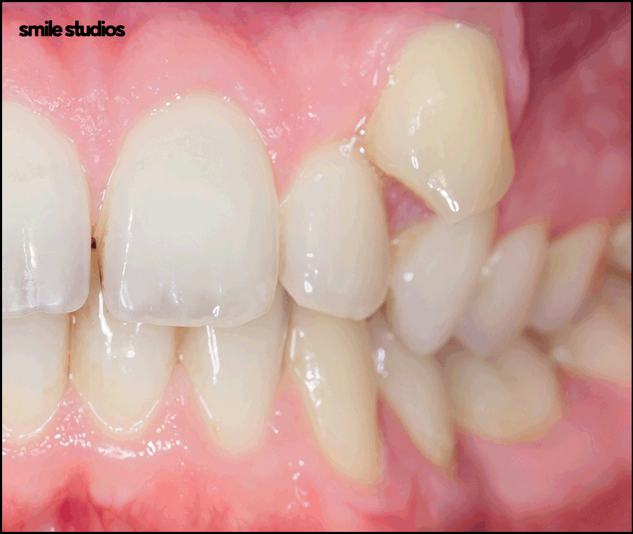 덧니라미네이트 해결 가능할까요? ft. 가능한 케이스 관련 이미지 9