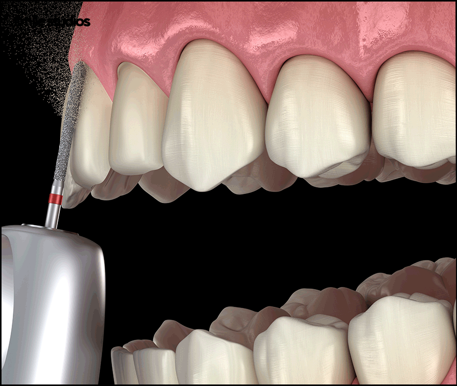 A Complete Guide to Laminate Replacement Timing, Lifespan, and Precautions image 7